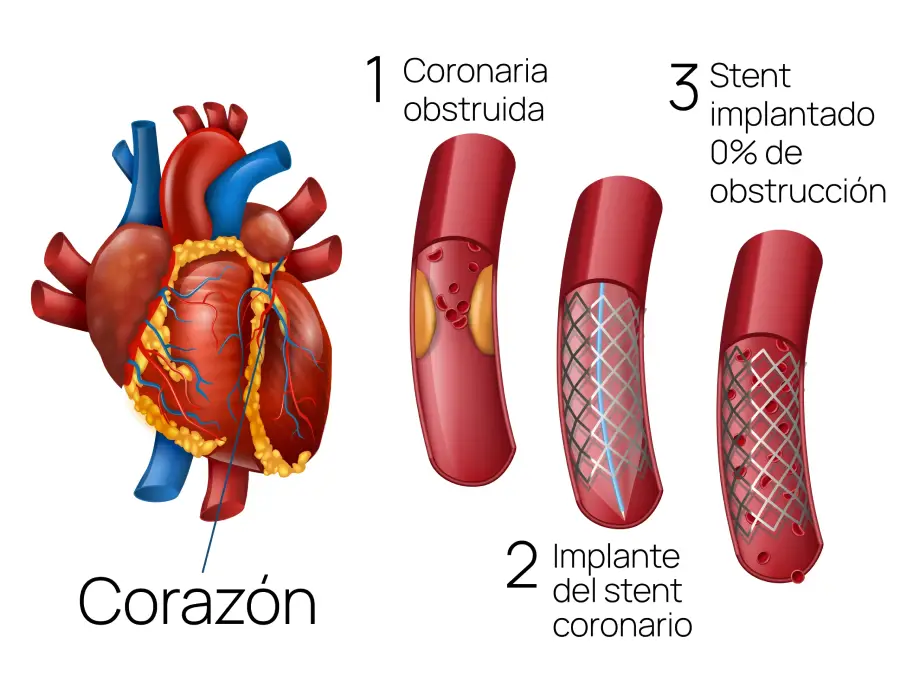 Ilustración anatómica del corazón mostrando las arterias coronarias